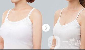 上?？s乳手術(shù)多少錢(qián),縮乳手術(shù)多少錢(qián)