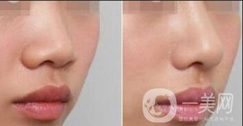 北京軟骨隆鼻手術(shù)多少錢