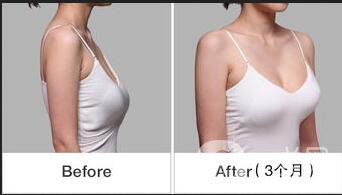 廣東乳房下垂矯正多少錢(qián),乳房下垂矯正多少錢(qián),乳房下垂矯正