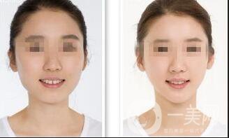 廣東射頻溶脂瘦臉價(jià)格,射頻溶脂瘦臉價(jià)格,射頻溶脂瘦臉