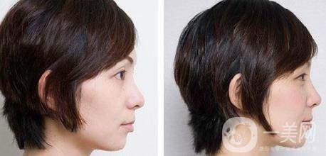 顴弓內(nèi)推手術(shù)主要有什么術(shù)后注意事項