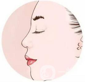 北京駝峰鼻矯正手術(shù)費用大概有多少