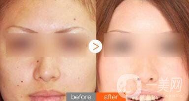 激光祛痣術(shù)后會留疤嗎