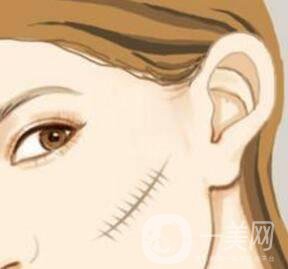 激光祛疤*果怎么樣？有什么優(yōu)勢(shì)