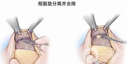 廣東頰脂墊去除價(jià)格