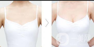 廣東假體豐胸費(fèi)用