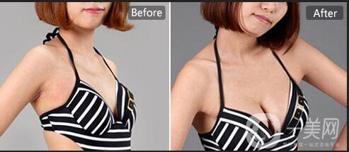 成都假體隆胸手術(shù)費用