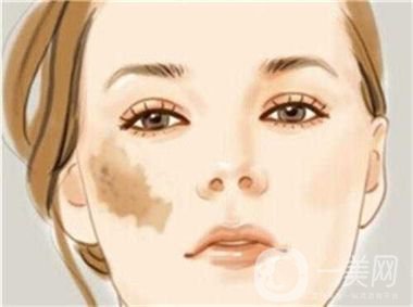 激光去咖啡斑恢復(fù)過(guò)程