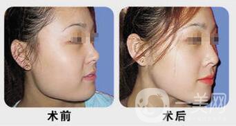 北京磨下頜角多少錢