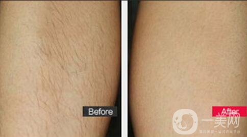 廣東冰點(diǎn)脫毛多少錢