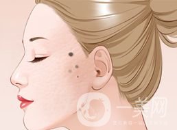 激光祛痣術(shù)后護(hù)理