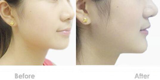 深圳墊下巴費用