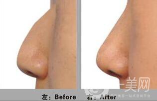 北京駝峰鼻矯正術(shù),價格