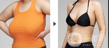 深圳大胸縮小手術(shù)多少錢(qián)