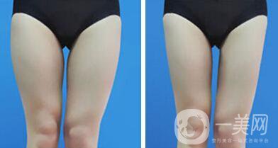 上海吸脂瘦大腿多少錢(qián)