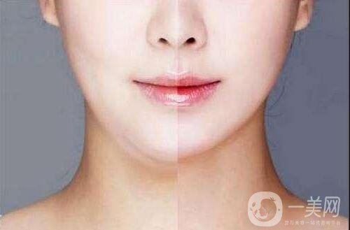 上海臉部抽脂多少錢