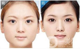 上海臉部抽脂多少錢