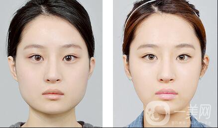 北京墊下巴多少錢(qián)