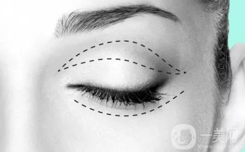割雙眼皮一個月恢復(fù)情況