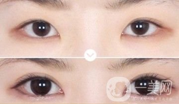 割雙眼皮一個月恢復(fù)情況