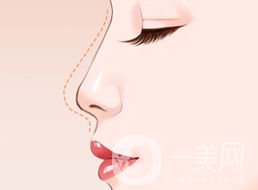 墊鼻尖用什么材料*好