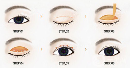 哪個(gè)割雙眼皮的方式比較好