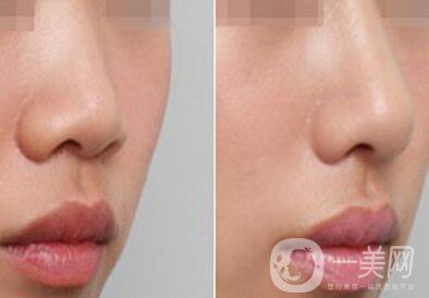 上海自軟體隆鼻多少錢(qián)