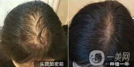 頭發(fā)種植*果靠譜嗎 *嗎