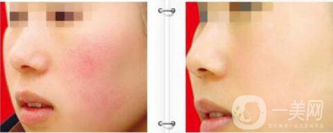 北京光子嫩膚多少錢