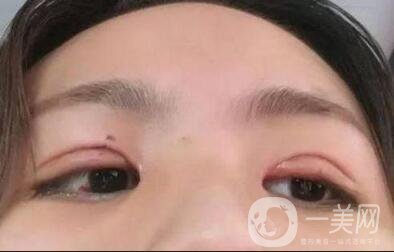 像素激光祛痘坑術(shù)后護(hù)理工作主要做些什么