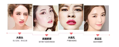 鼻翼縮小手術(shù)的價(jià)錢