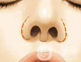 鼻翼縮小手術(shù)價(jià)錢 