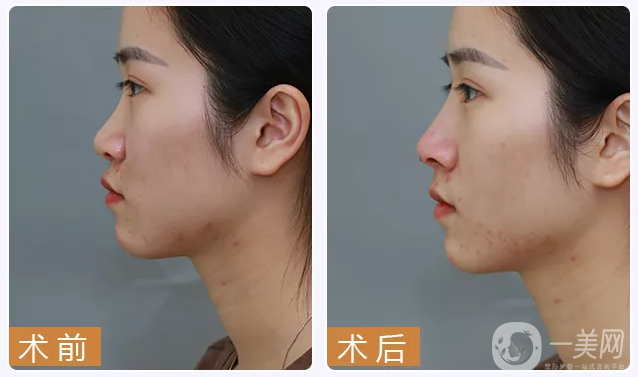 自體隆鼻一般多少錢