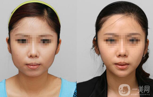 超聲法瘦臉報(bào)價(jià) 