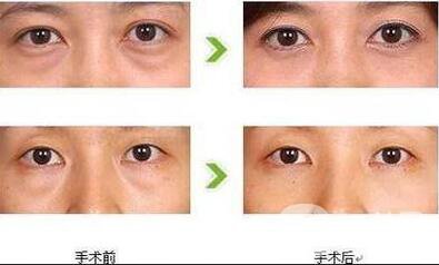 外切去眼袋修復(fù)價(jià)格