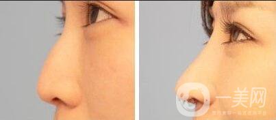 假體隆鼻價(jià)格多少