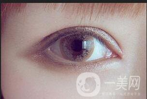 溶脂去眼袋修復(fù)價(jià)格