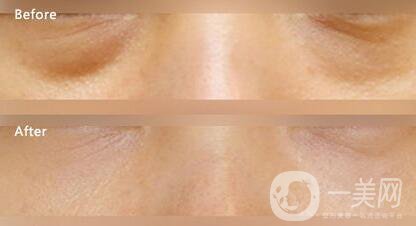 溶脂去眼袋修復(fù)價(jià)格