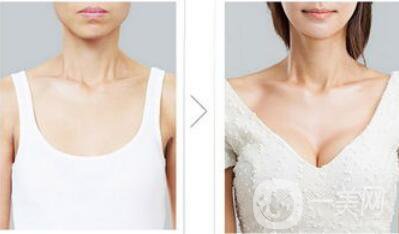 脂肪隆胸整形手術(shù)價(jià)格