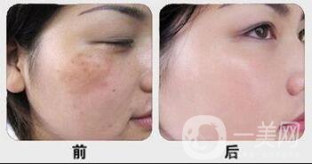 激光祛斑價(jià)格