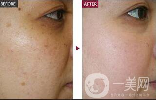 祛斑價錢,激光祛斑價格