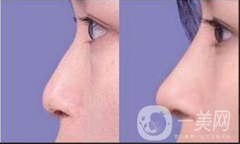 鼻翼縮小手術價格,鼻翼縮小