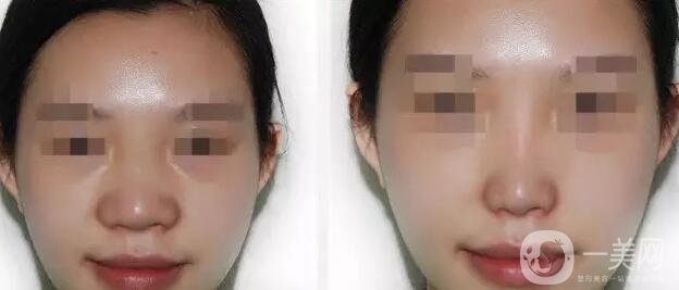 鼻翼縮小手術(shù)費(fèi)用,鼻翼縮小價(jià)格