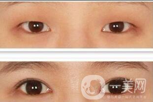 雙眼皮貴不貴,雙眼皮價格