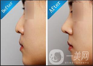 自體隆鼻多少錢