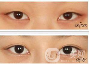 西安開眼角手術(shù)價格,開眼角手術(shù)價格,開眼角