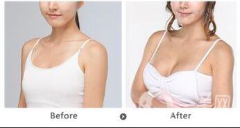 長春假體豐胸多少錢