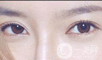 鄭州開(kāi)眼角*果