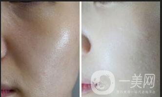 光子嫩膚多少錢