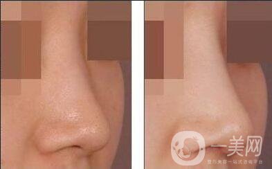 瑞蘭玻尿酸隆鼻價格